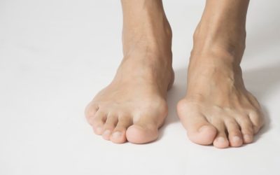 Hallux valgus (oignon au pied) : définition, causes, symptômes et traitements