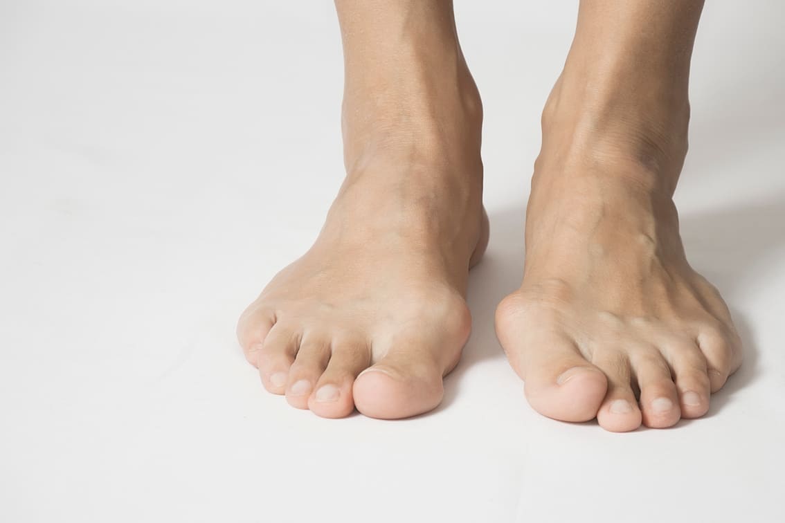 Photo d'un hallux valgus